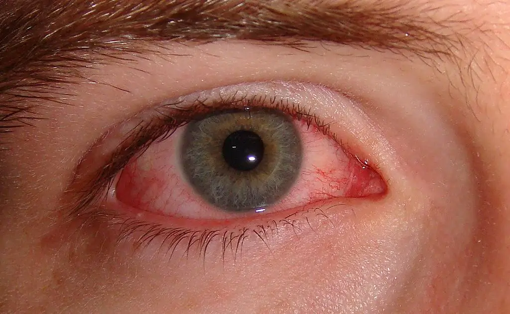 Är Pink Eye ett symptom på covid-19?  |